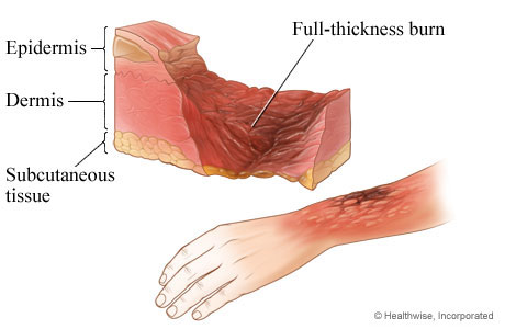 burn and subcutaneous tissue