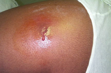 MRSA Methicillin Resistant Staphalococcus - Staph Infection - Abscess