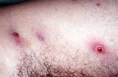 MRSA Methicillin Resistant Staphalococcus - Staph Infection - Carbuncles