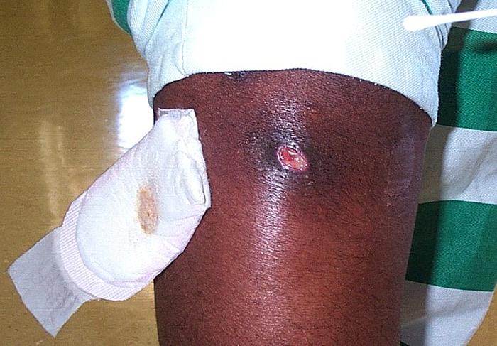 MRSA Methicillin Resistant Staphalococcus - Staph Infection - Knee Infection