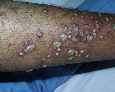 MRSA Methicillin Resistant Staphalococcus - Staph Infection - Staph On Leg